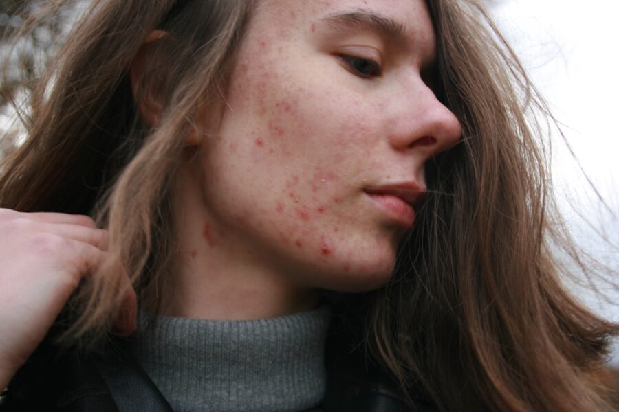Adult acne skincare routine beside a mirror with simple daily products